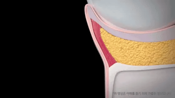 Dr. Melaxin Eyephalt Before and After Results